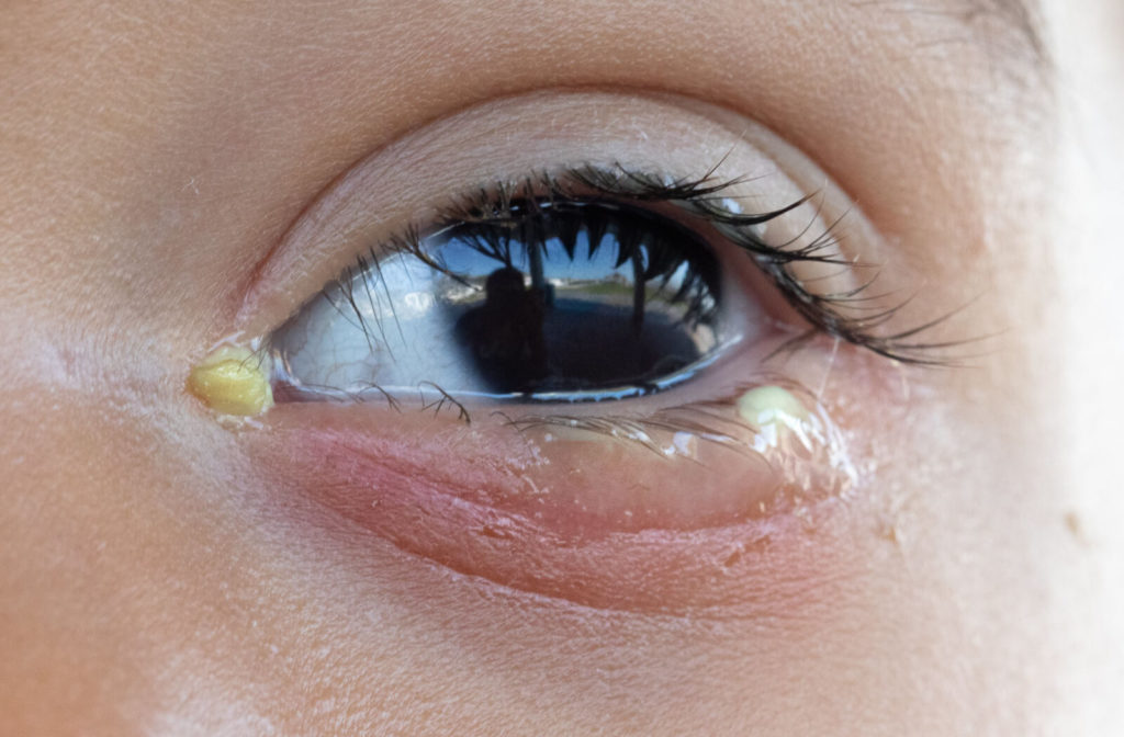 A close-up front view of a child's eye suffering from bacterial conjunctivitis, causing teary eyes and  mucus build up.