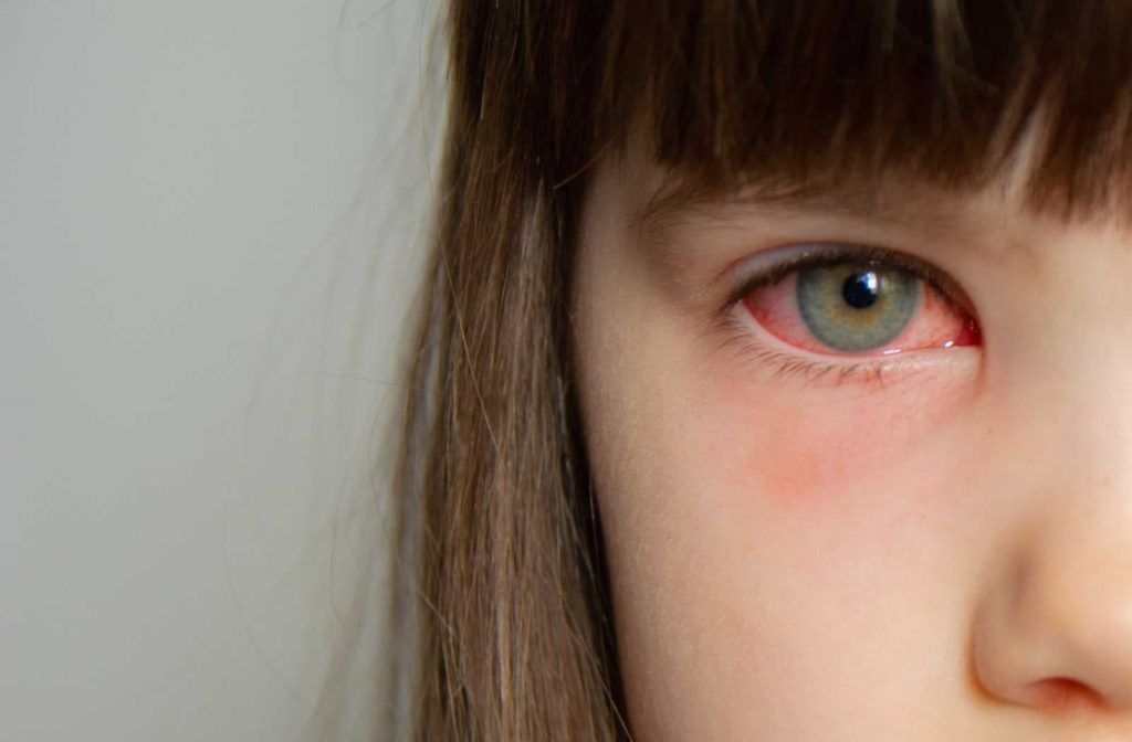 A close-up face of a young girl with conjunctivitis in her eyes.