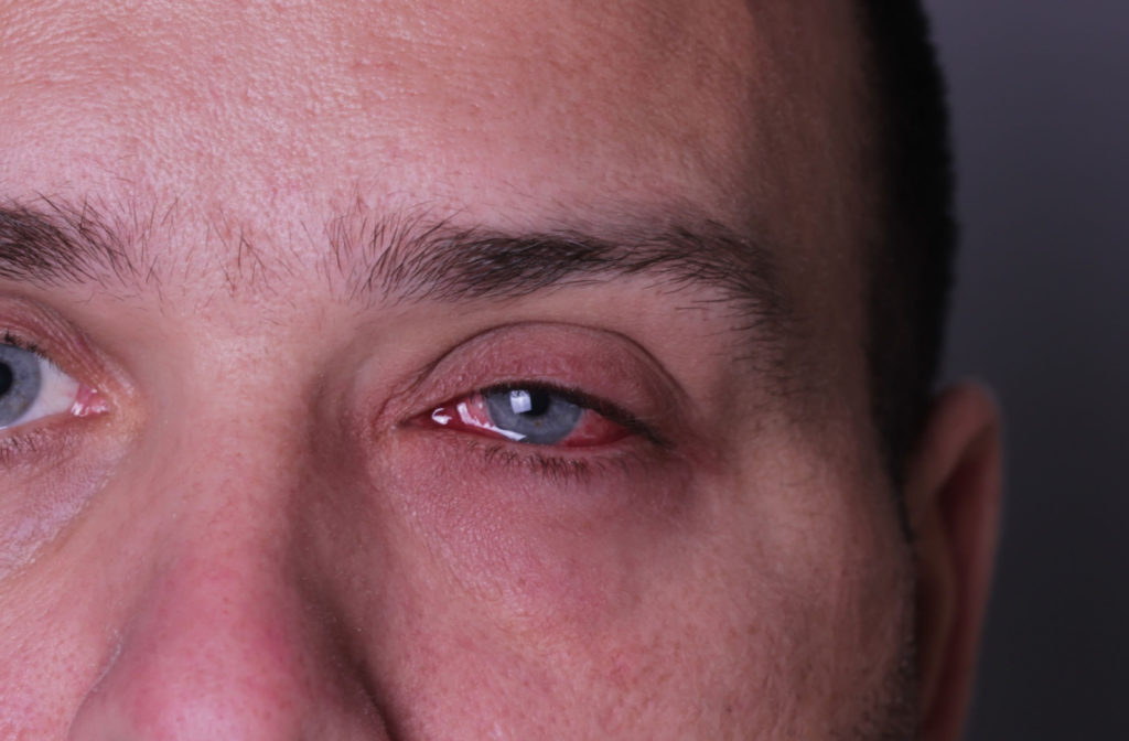 A close-up of a man's teary and red left eye which is a symptom of conjunctivitis.